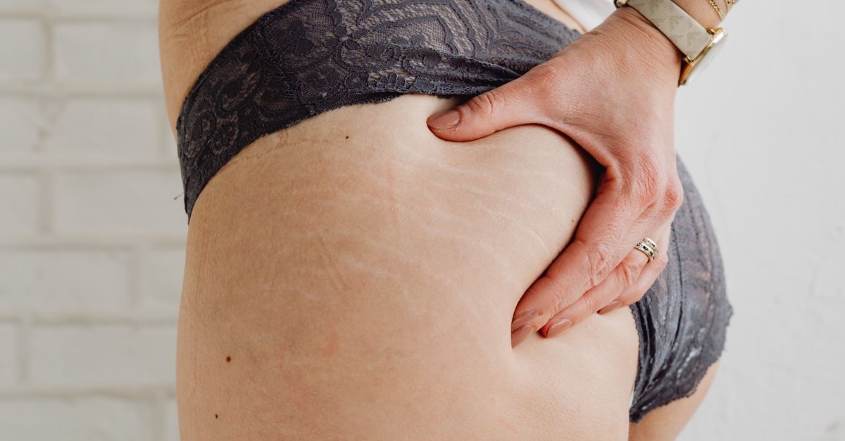 Pożegnaj rozstępy: serum, które regeneruje skórę pośladków i przywraca jej gładkość